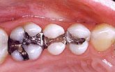 photo of three teeth filled with silver mercury amalgam fillings
