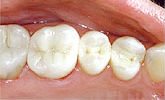 the same three teeth as those above after they have been filled with white composite filings