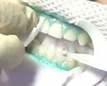zoom teeth whitening kalamazoo MI dentist
