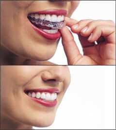 A woman placing her Invisalign aligners