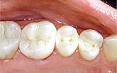 After photo of molar teeth with white fillings that were replaced by a mercury-free dentist like Dr. Susan Dennis in Portage, MI.