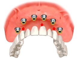 Image of an upper implant overdenture