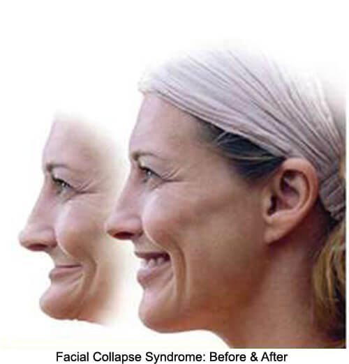 Dental Implants after Dentures - Susan M. Dennis, D.D.S