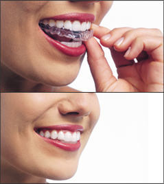 Two images showing Invisalign. The top image has the aligners being placed. The bottom image has the aligners on.