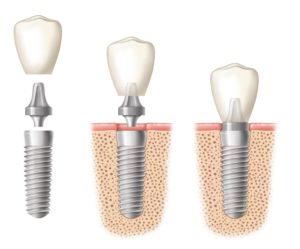 placing of dental implant in three stages