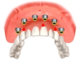 Implant overdentures illustration