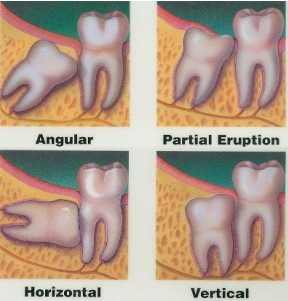 images of four types of impacted wisdom teeth