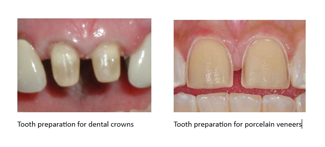 A tooth preparation comparison of porcelain crowns versus porcelain veneers