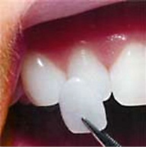 A single porcelain veneer being held up o a tooth