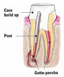 An image of a dental post in a tooth.