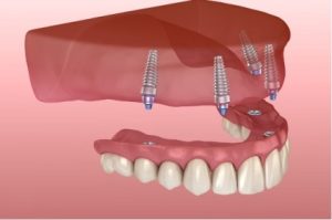 upper implant supported dentures