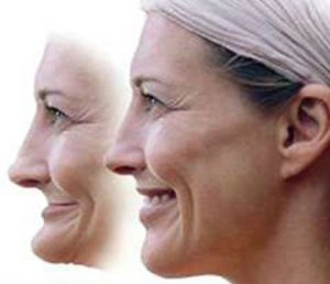 Before and after facial collapse