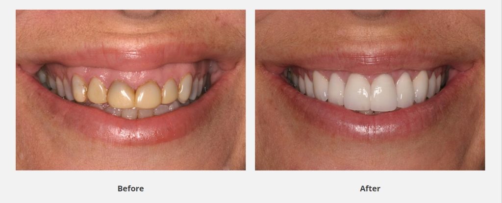 before and after tetracycline stains images