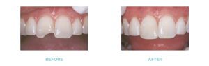 Before and after images of dental bonding on a chipped tooth.
