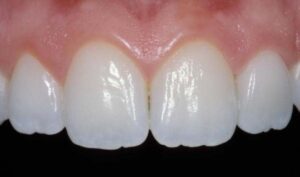 Porcelain veneers