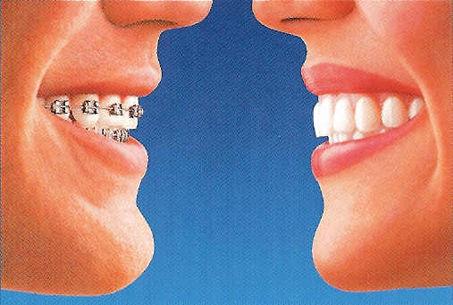 Comparison of braces with Invisalign